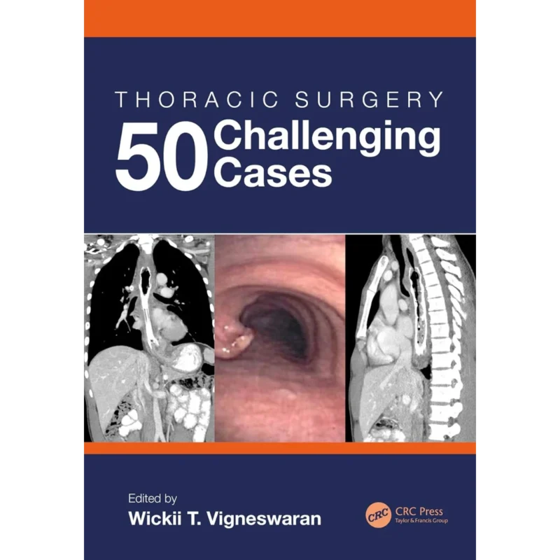 Thoracic Surgery: 50 Challenging cases