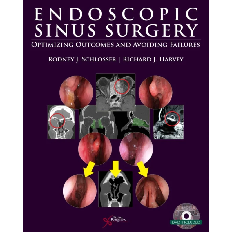 Endoscopic Sinus Surgery: Optimizing Outcomes and Avoiding Failures